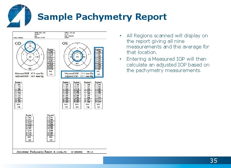 Sample Pachymetry Report • • All Regions scanned will display on the report giving