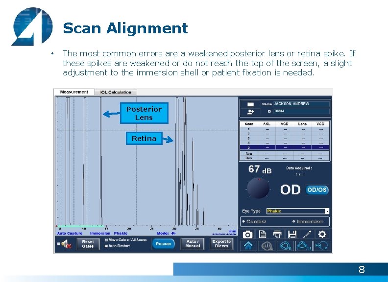 Scan Alignment • The most common errors are a weakened posterior lens or retina