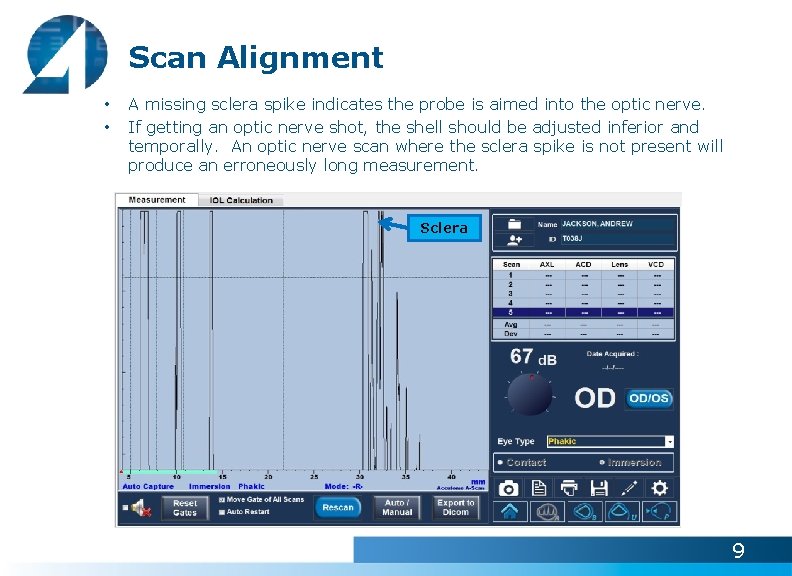 Scan Alignment • • A missing sclera spike indicates the probe is aimed into