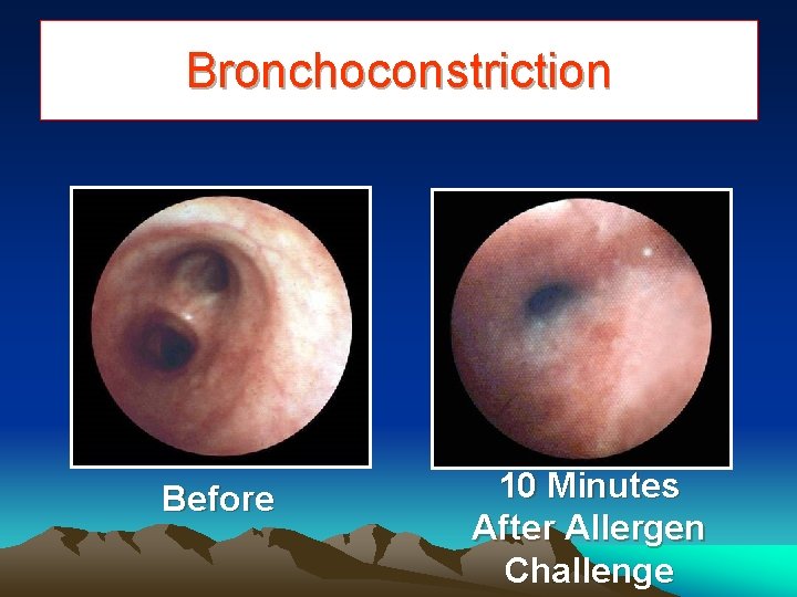 Bronchoconstriction Before 10 Minutes After Allergen Challenge 