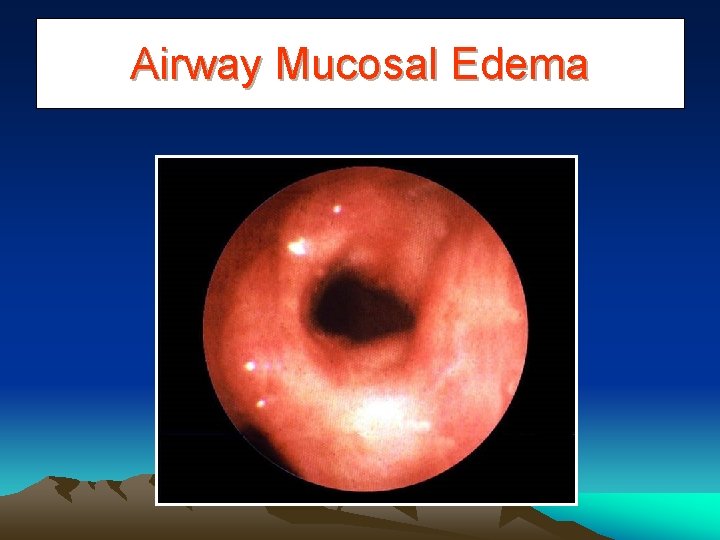 Airway Mucosal Edema 