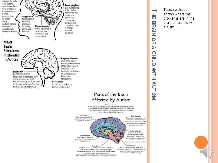 THE BRAIN OF A CHILD WITH AUTISM These pictures shows where the problems are