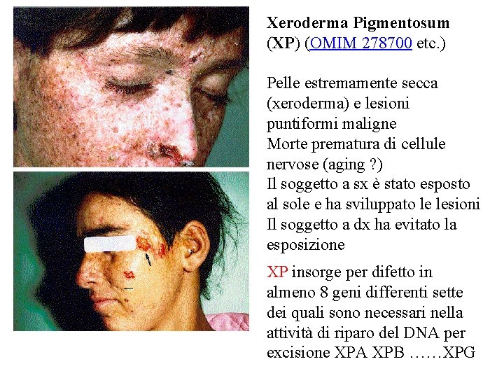 Xeroderma Pigmentosum (XP) (OMIM 278700 etc. ) Pelle estremamente secca (xeroderma) e lesioni puntiformi