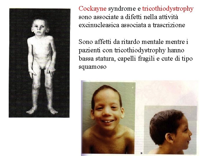 Cockayne syndrome e tricothiodystrophy sono associate a difetti nella attività excinucleasica associata a trascrizione