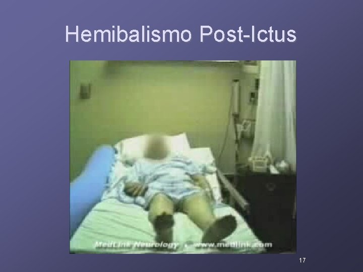 Hemibalismo Post-Ictus 17 