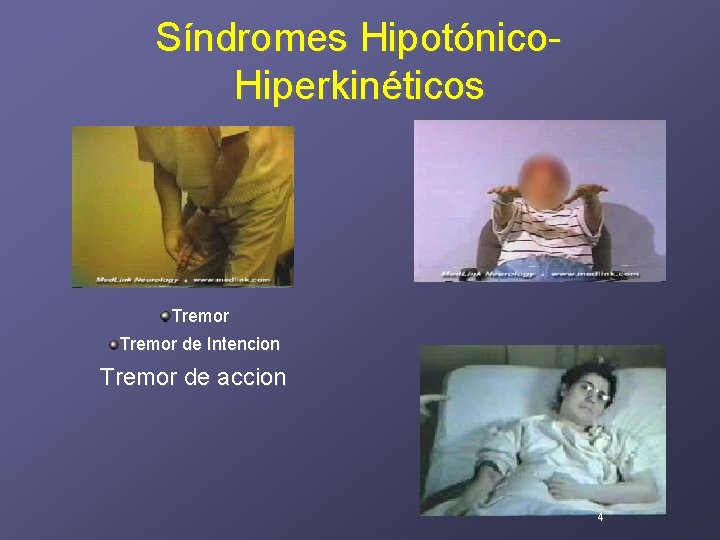 Síndromes Hipotónico. Hiperkinéticos Tremor de Intencion Tremor de accion 4 