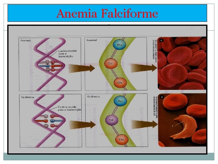 Anemia Falciforme 