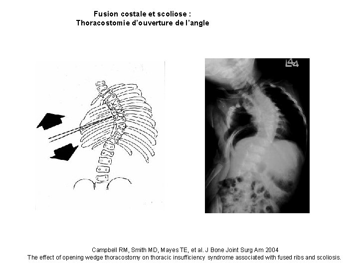 Fusion costale et scoliose : Thoracostomie d’ouverture de l’angle Campbell RM, Smith MD, Mayes