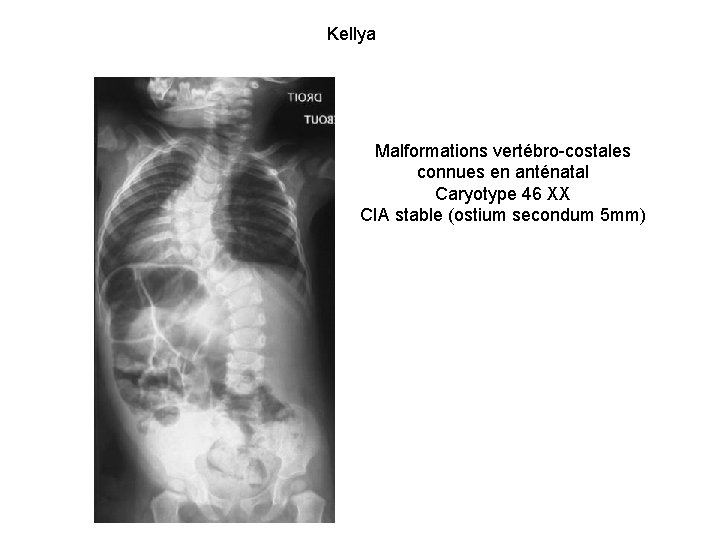 Kellya Malformations vertébro-costales connues en anténatal Caryotype 46 XX CIA stable (ostium secondum 5