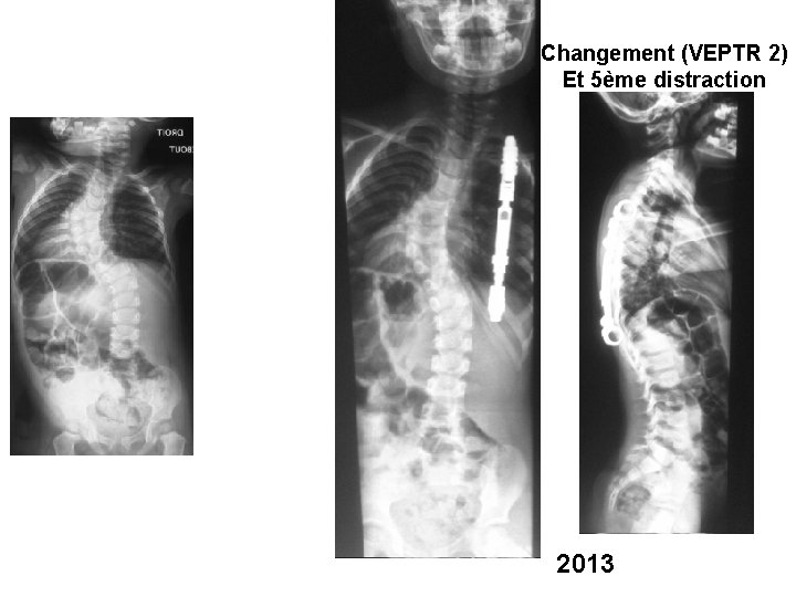 Changement (VEPTR 2) Et 5ème distraction 2013 