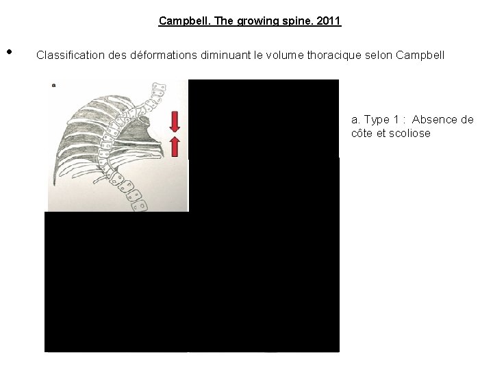 Campbell. The growing spine. 2011 • Classification des déformations diminuant le volume thoracique selon