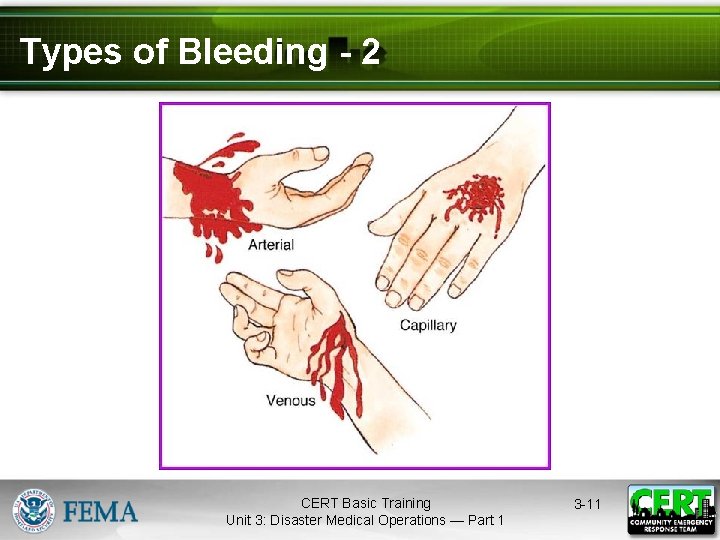 Types of Bleeding - 2 CERT Basic Training Unit 3: Disaster Medical Operations —