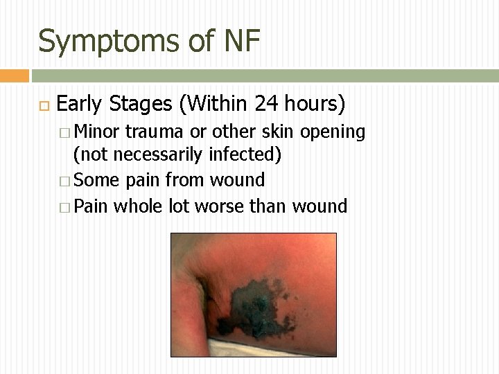 Symptoms of NF Early Stages (Within 24 hours) � Minor trauma or other skin