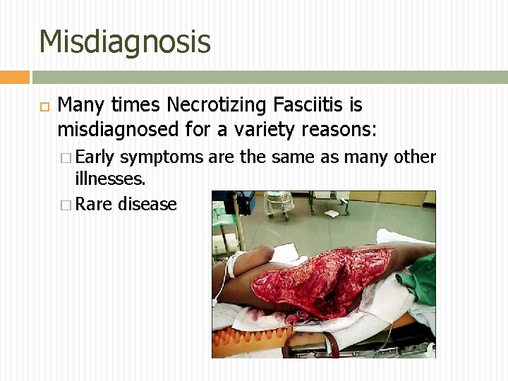 Misdiagnosis Many times Necrotizing Fasciitis is misdiagnosed for a variety reasons: � Early symptoms