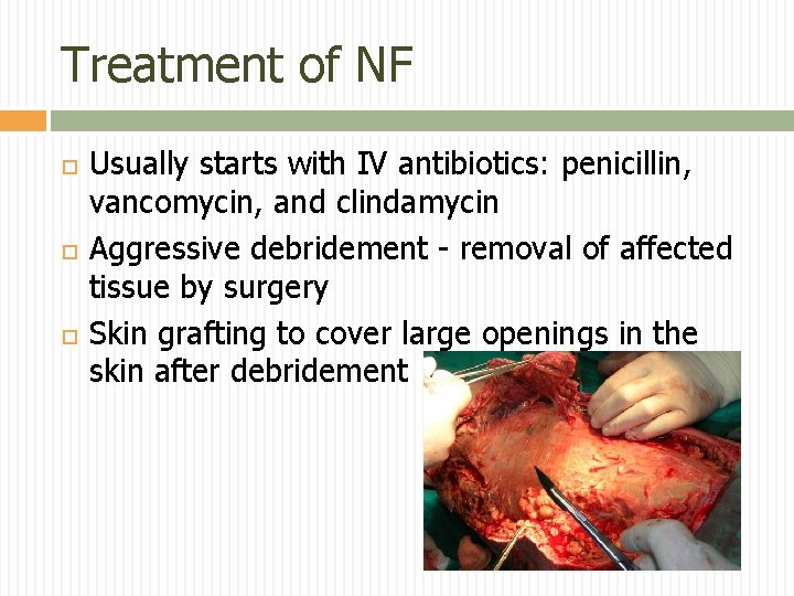 Treatment of NF Usually starts with IV antibiotics: penicillin, vancomycin, and clindamycin Aggressive debridement