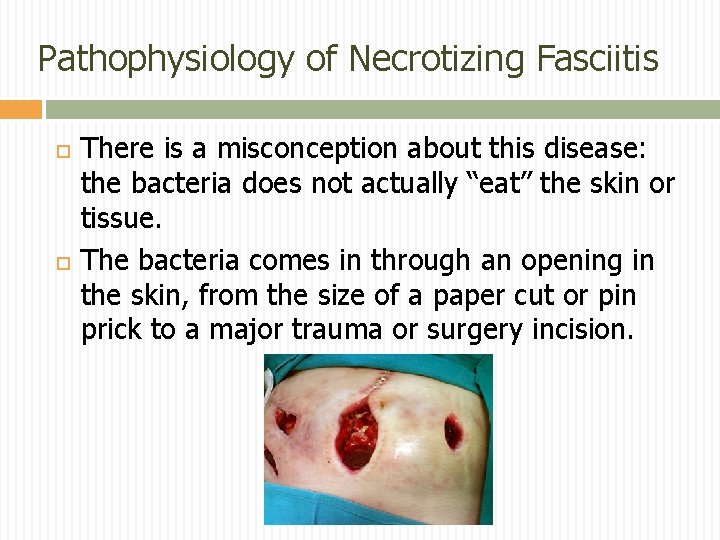 Pathophysiology of Necrotizing Fasciitis There is a misconception about this disease: the bacteria does