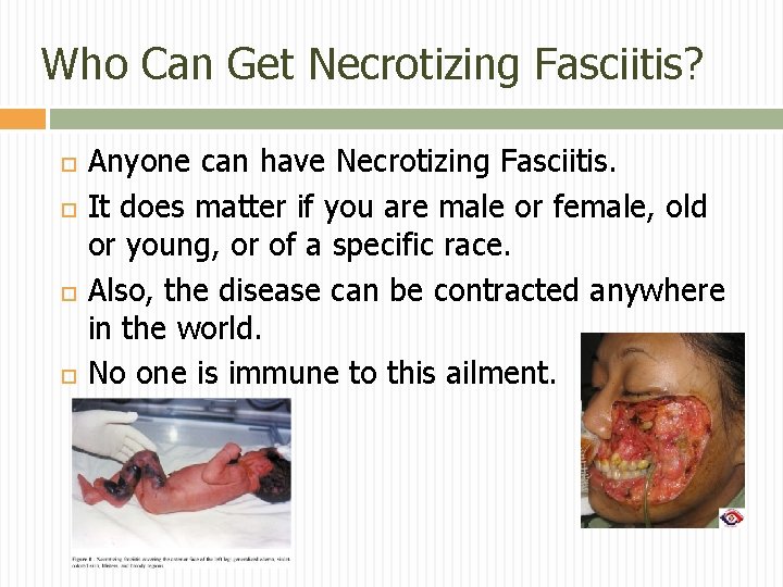 Who Can Get Necrotizing Fasciitis? Anyone can have Necrotizing Fasciitis. It does matter if