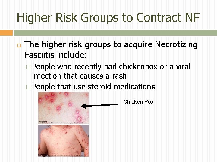 Higher Risk Groups to Contract NF The higher risk groups to acquire Necrotizing Fasciitis