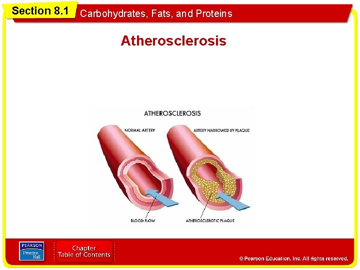 Section 8. 1 Carbohydrates, Fats, and Proteins Atherosclerosis 