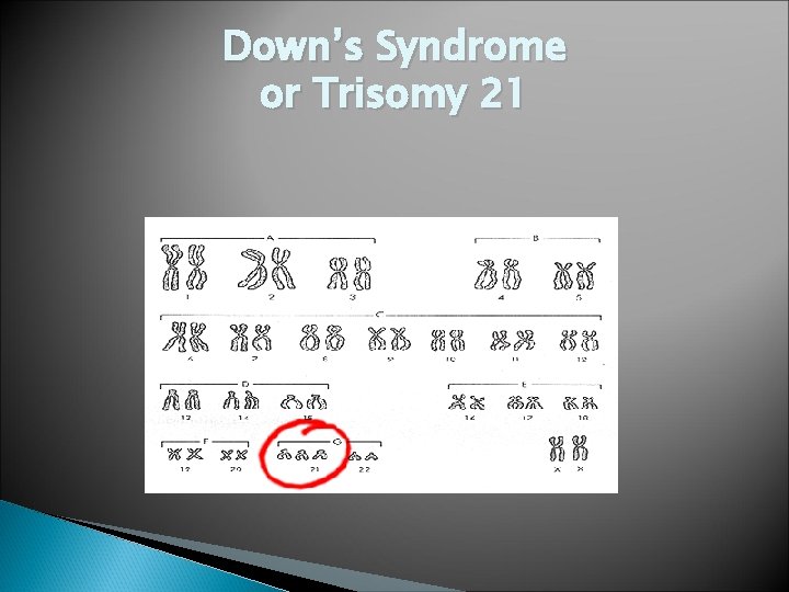 Down’s Syndrome or Trisomy 21 