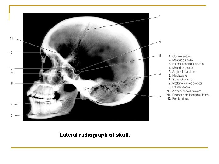 Lateral radiograph of skull. Lateral radiograph of skull.
