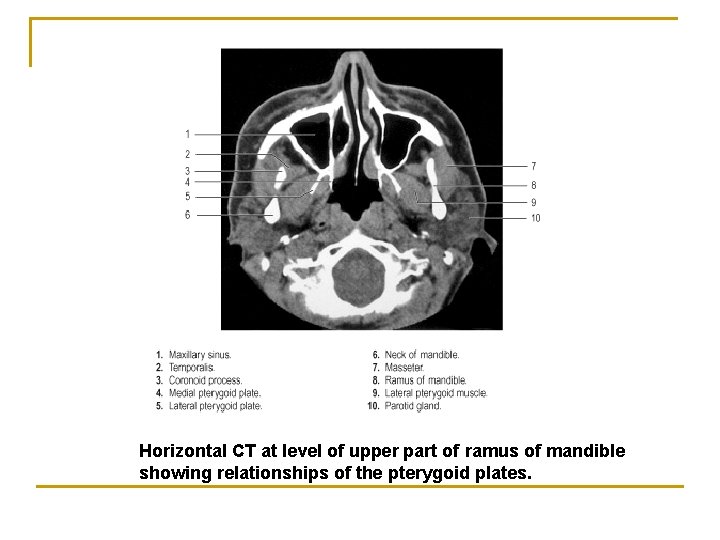 Horizontal CT at level of upper part of ramus of mandible showing relationships of