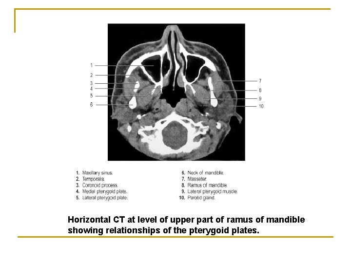 Horizontal CT at level of upper part of ramus of mandible showing relationships of Horizontal CT at level of upper part of ramus of mandible showing relationships of