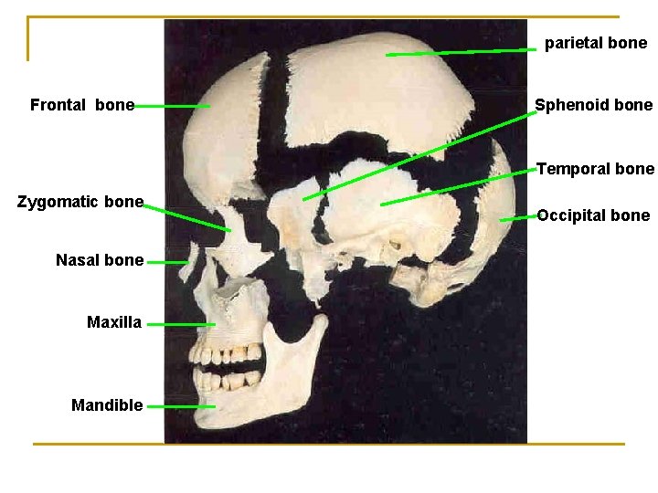 parietal bone Frontal bone Sphenoid bone Temporal bone Zygomatic bone Nasal bone Maxilla Mandible parietal bone Frontal bone Sphenoid bone Temporal bone Zygomatic bone Nasal bone Maxilla Mandible