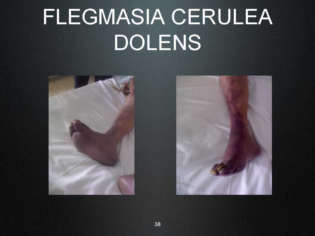 FLEGMASIA CERULEA DOLENS 38 
