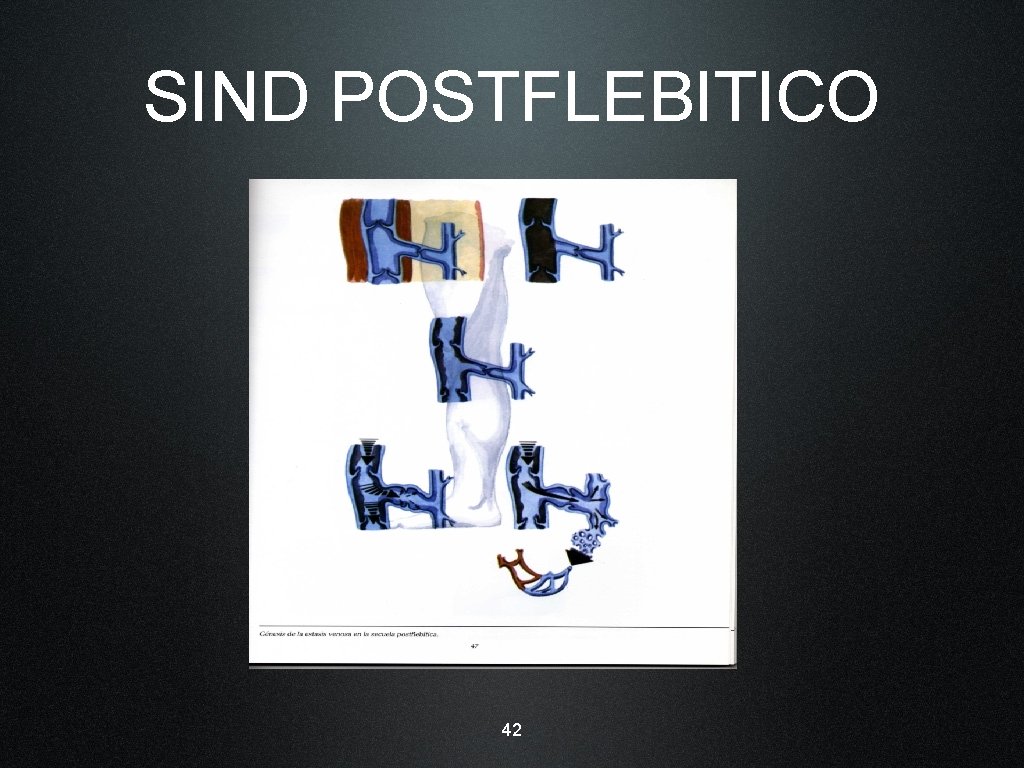 SIND POSTFLEBITICO 42 