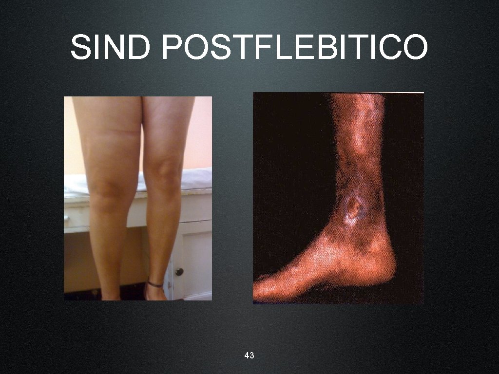 SIND POSTFLEBITICO 43 