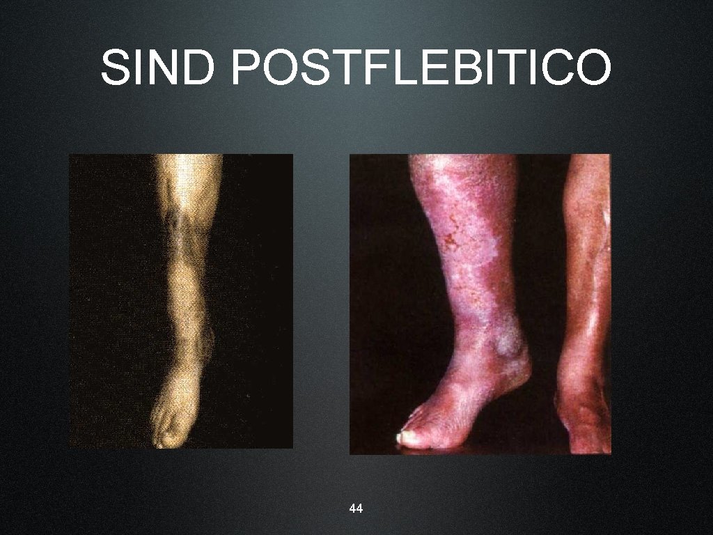 SIND POSTFLEBITICO 44 