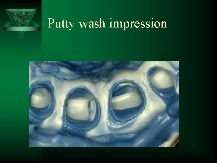 Putty wash impression 