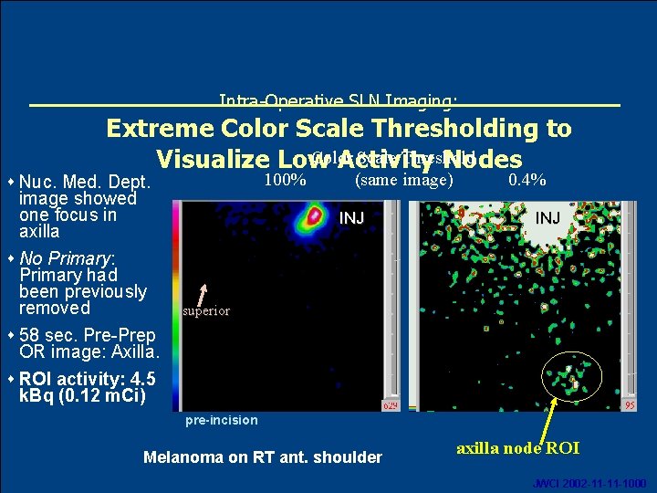 Intra-Operative SLN Imaging: Extreme Color Scale Thresholding to Color Scale Threshold Visualize Low Activity