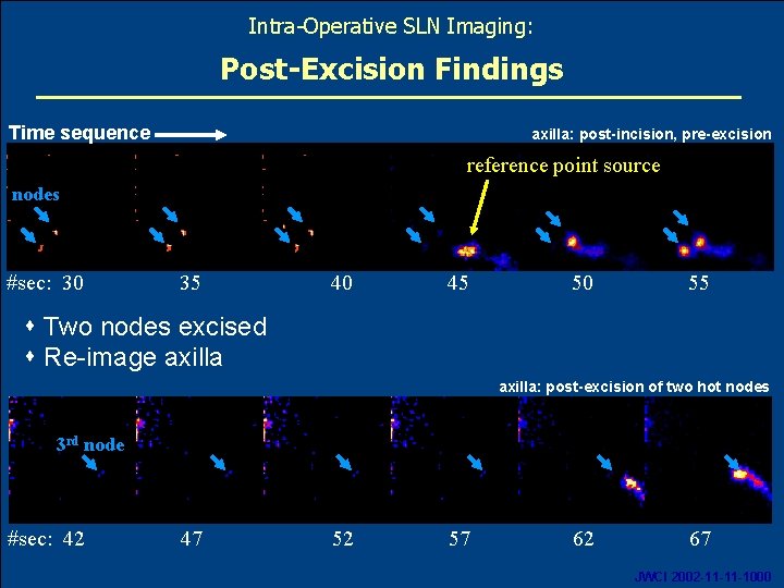 Intra-Operative SLN Imaging: Post-Excision Findings Time sequence axilla: post-incision, pre-excision reference point source nodes