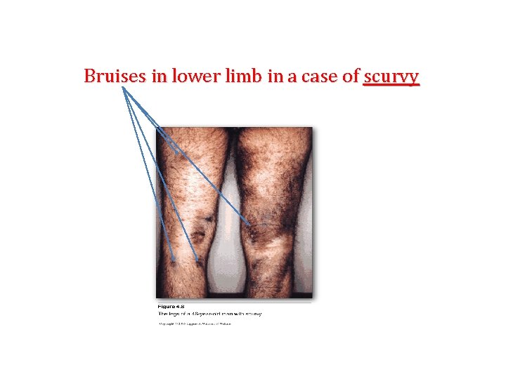 Bruises in lower limb in a case of scurvy 