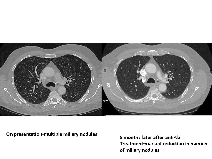 On presentation-multiple miliary nodules 8 months later after anti-tb Treatment-marked reduction in number of