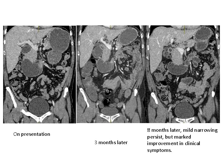 On presentation 3 months later 8 months later, mild narrowing persist, but marked improvement