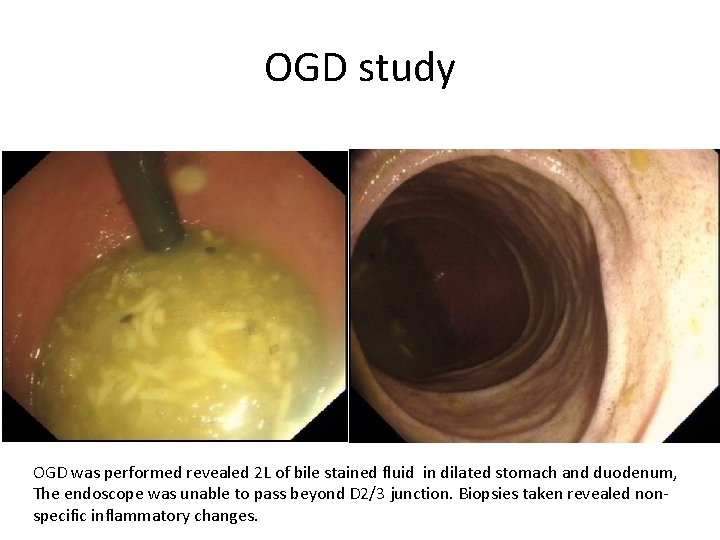 OGD study OGD was performed revealed 2 L of bile stained fluid in dilated