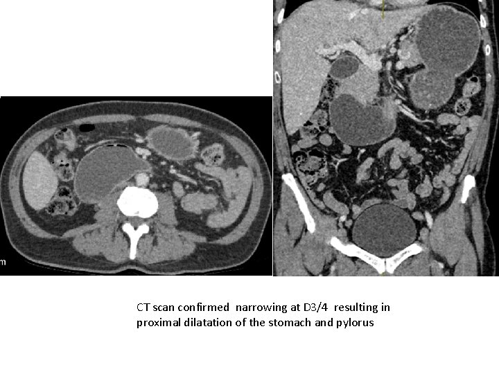 CT scan confirmed narrowing at D 3/4 resulting in proximal dilatation of the stomach