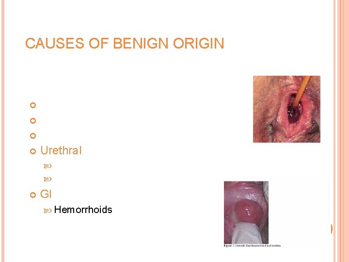 CAUSES OF BENIGN ORIGIN Uterine Vaginal or labial lesions Cervical lesions Urethral Caruncle Diverticulum