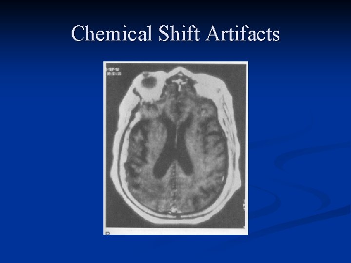 Chemical Shift Artifacts 
