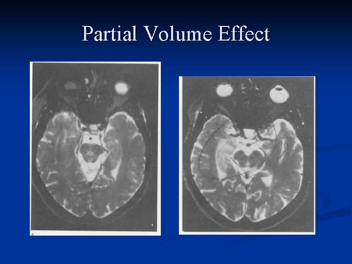 Partial Volume Effect 
