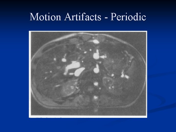 Motion Artifacts - Periodic 