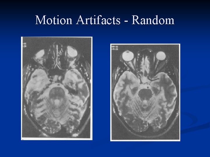 Motion Artifacts - Random 