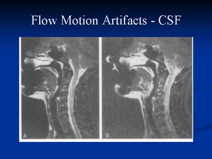 Flow Motion Artifacts - CSF 