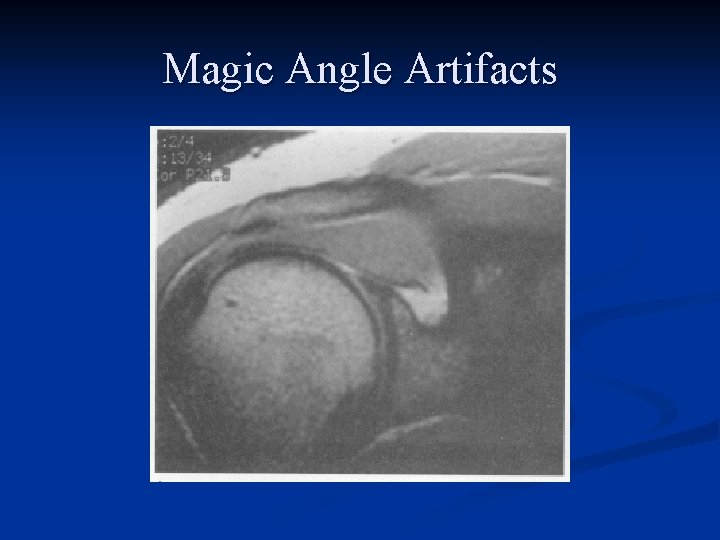 Magic Angle Artifacts 