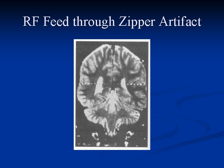 RF Feed through Zipper Artifact 