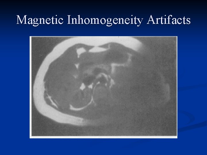 Magnetic Inhomogeneity Artifacts 