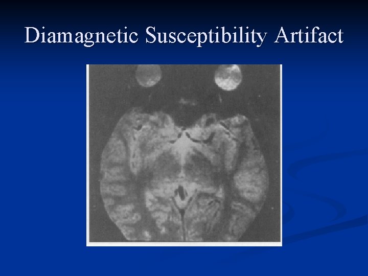 Diamagnetic Susceptibility Artifact 